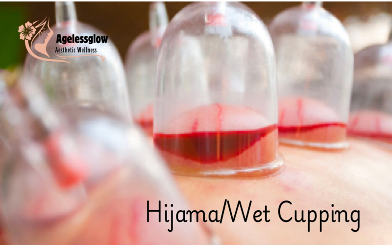 Hijama Wet Cupping 800x500 1